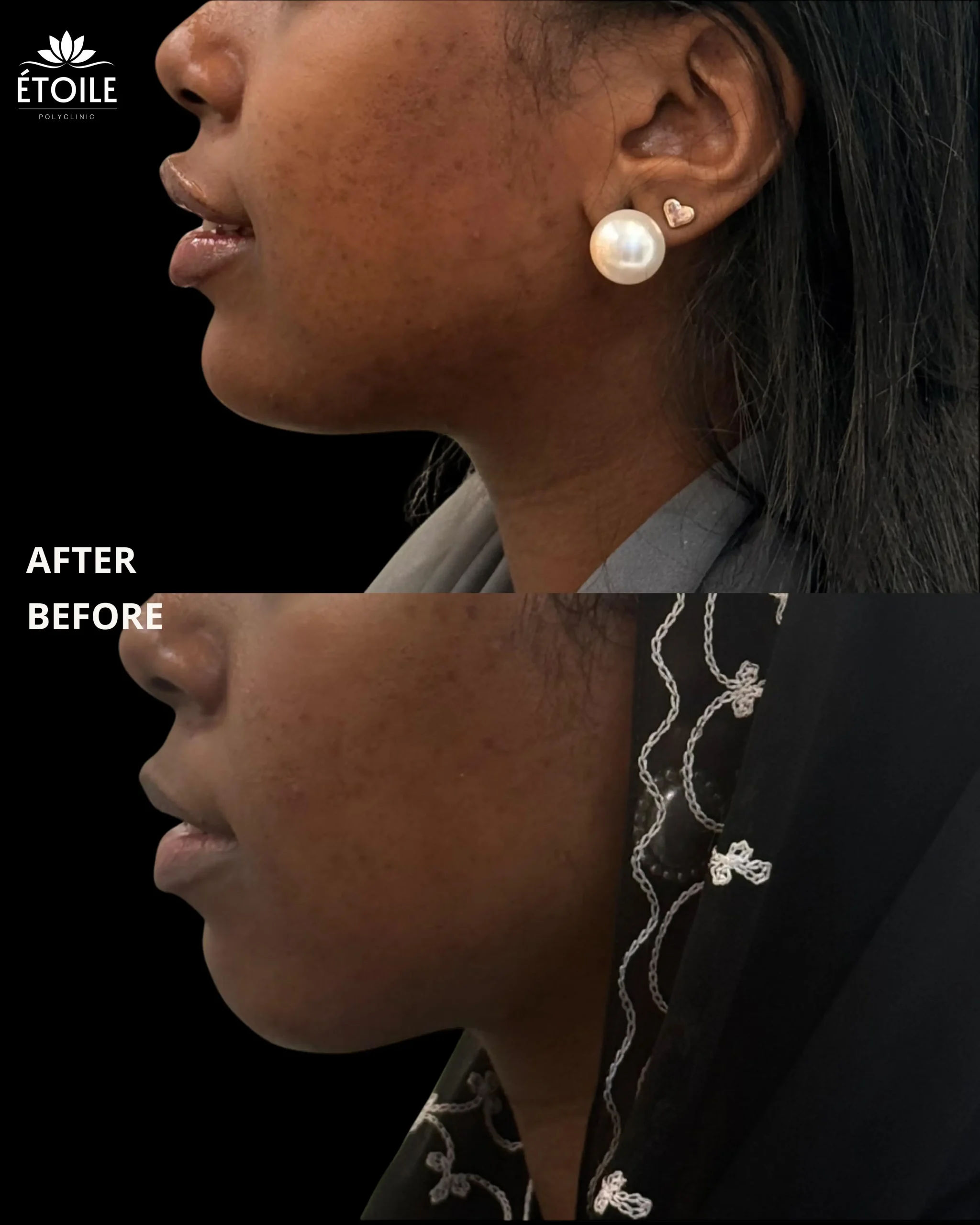 jawline filler 2