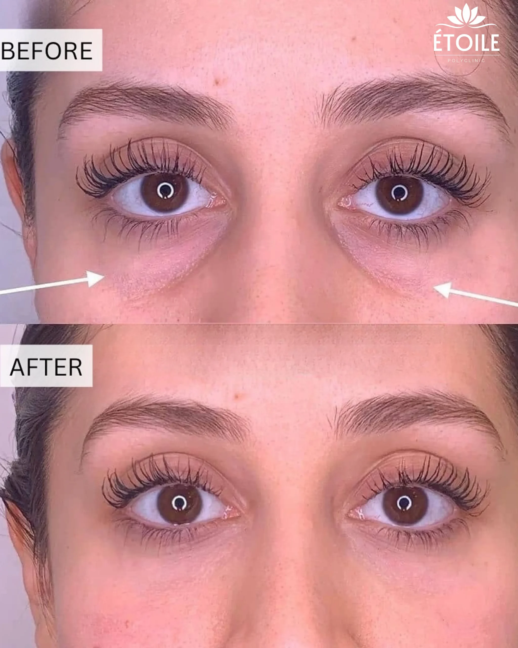 plasma gel for under eyes