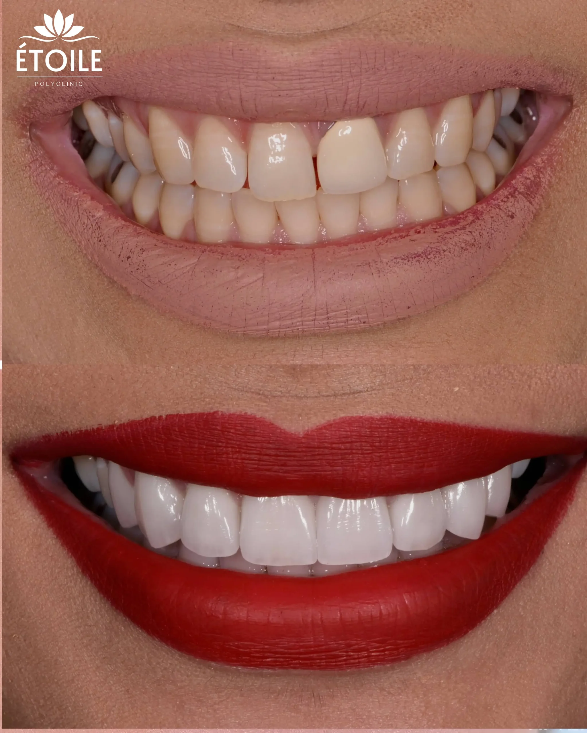 veneers 1