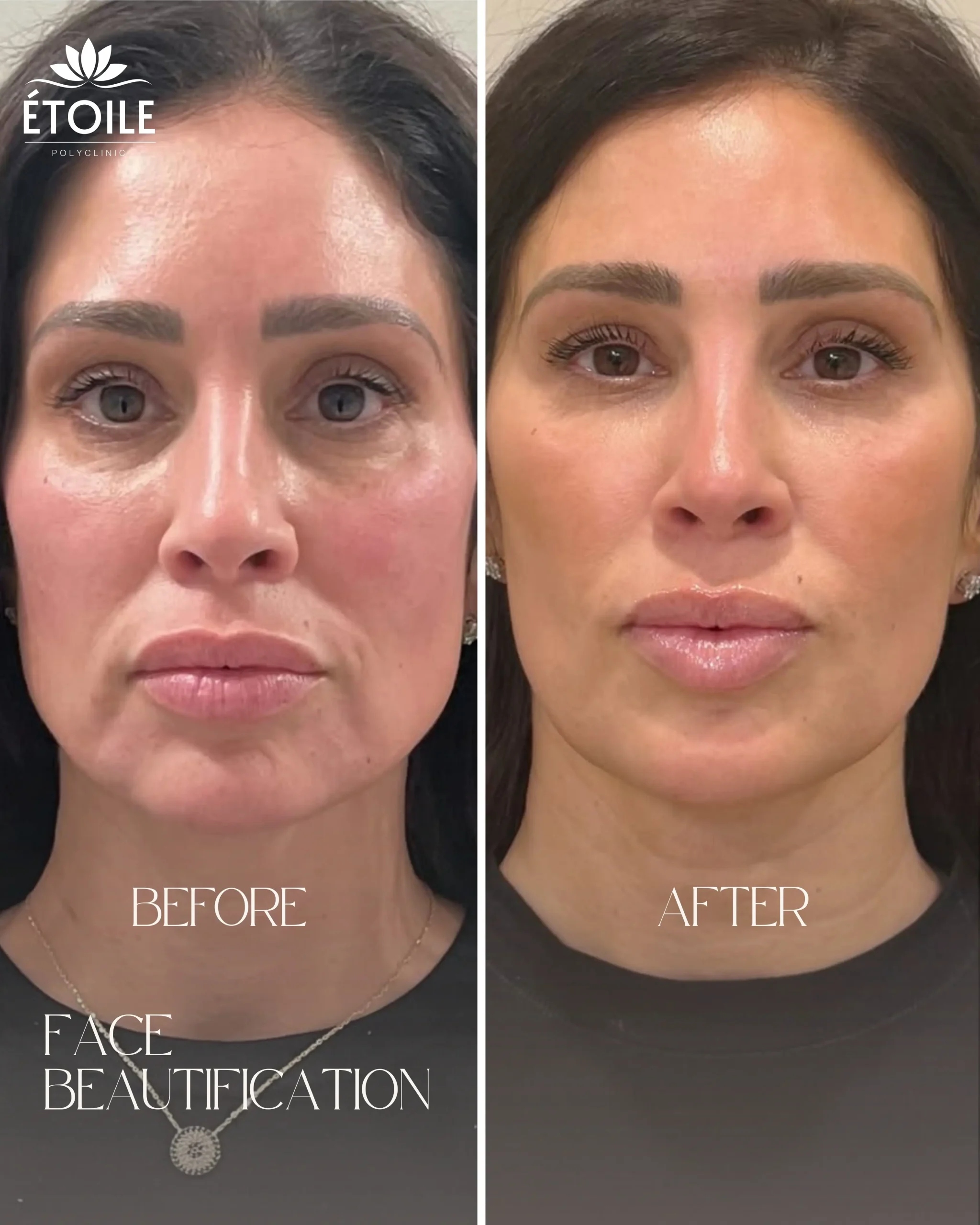 full face beautification 2
