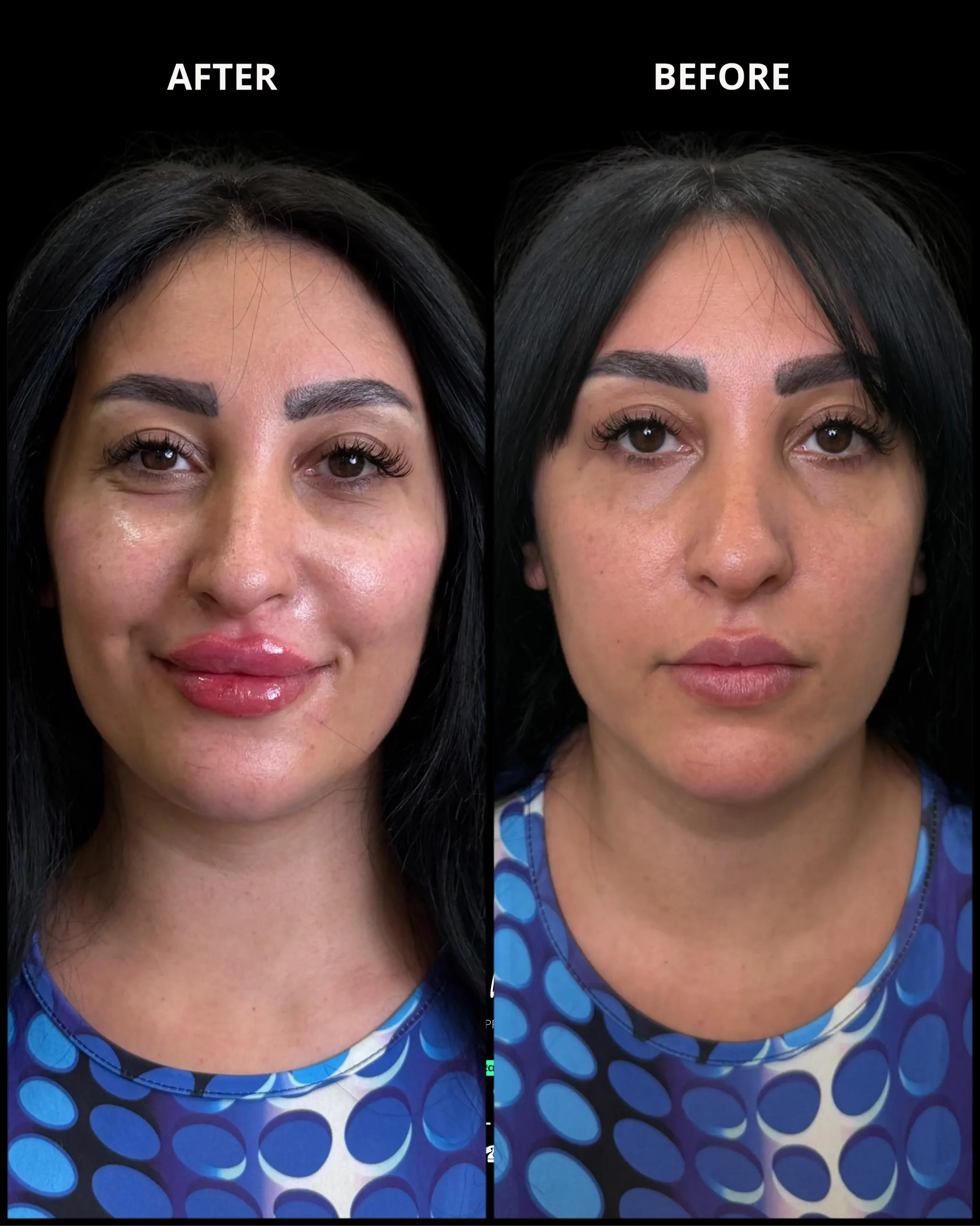 full face transformation