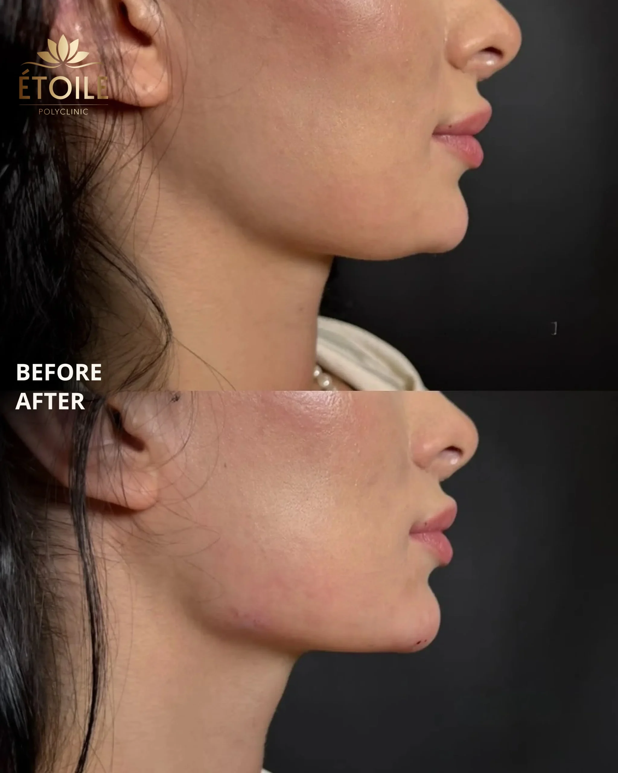 jawline filler 3