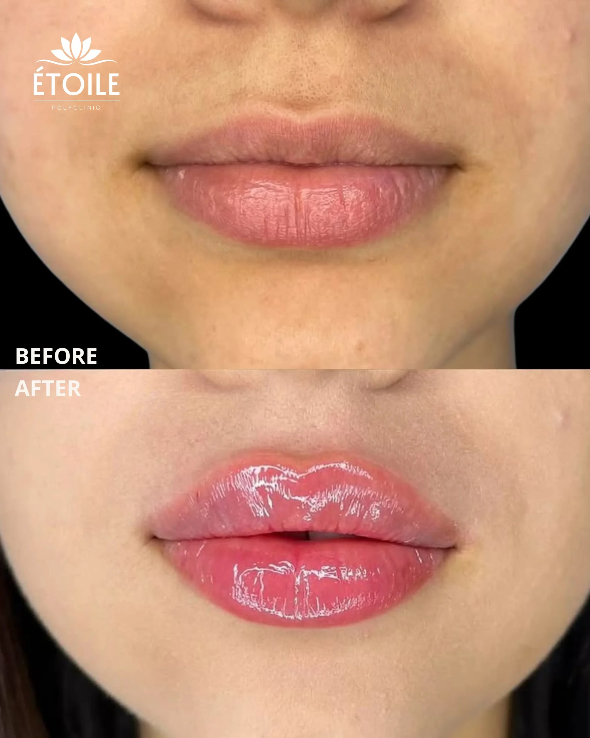 lips filler