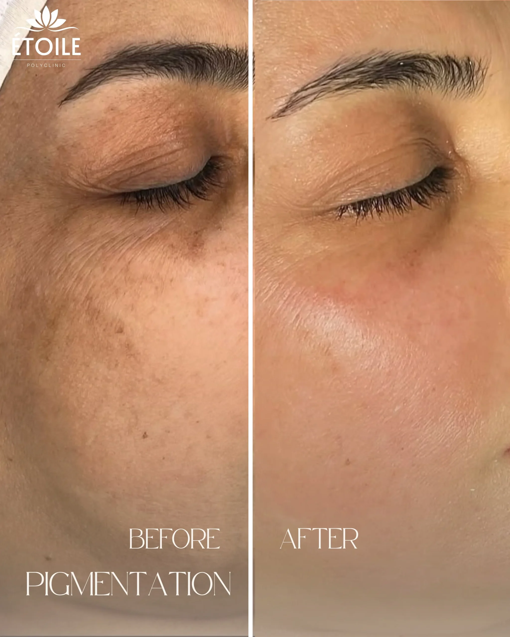 pigmentation treatement