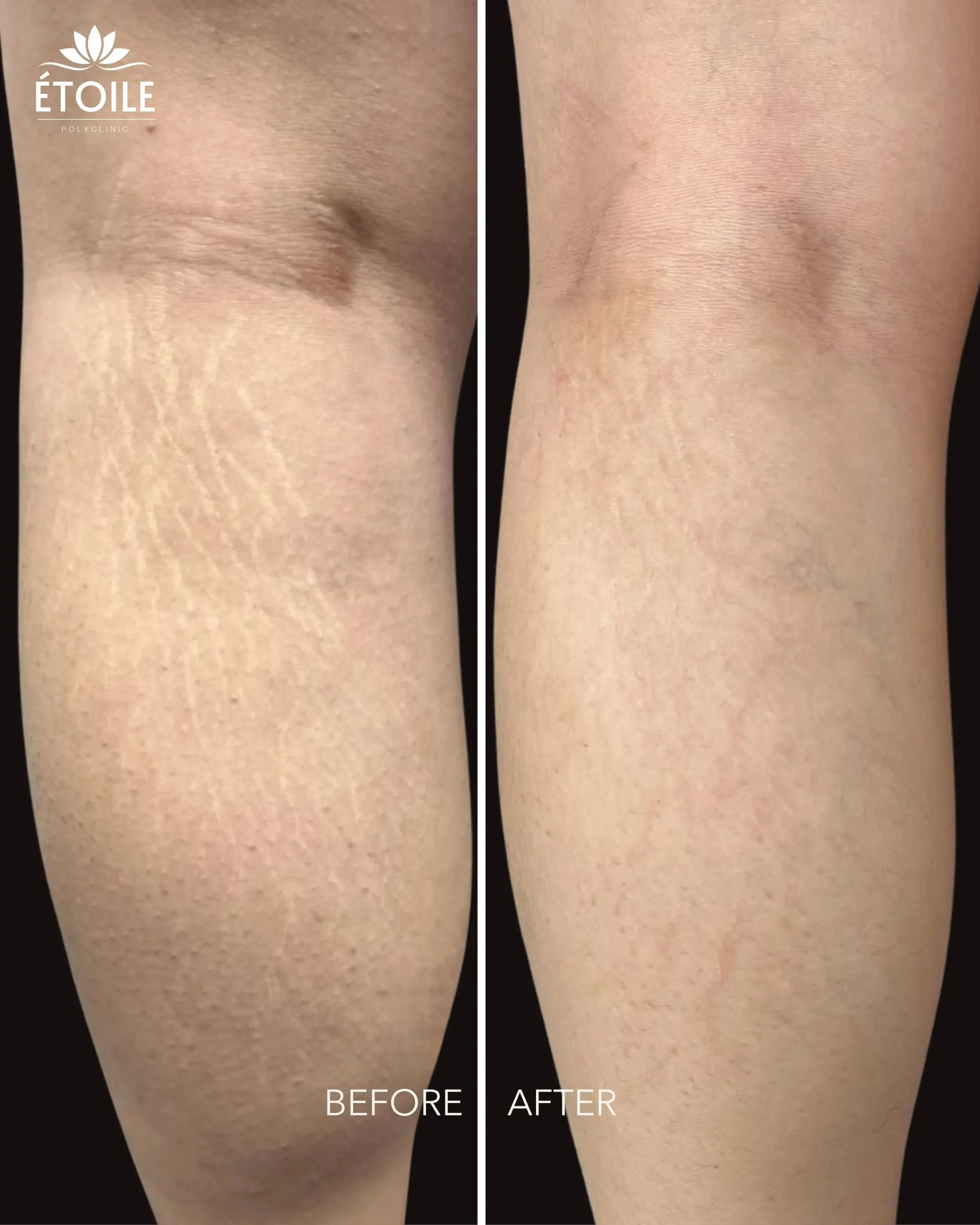stretch marks