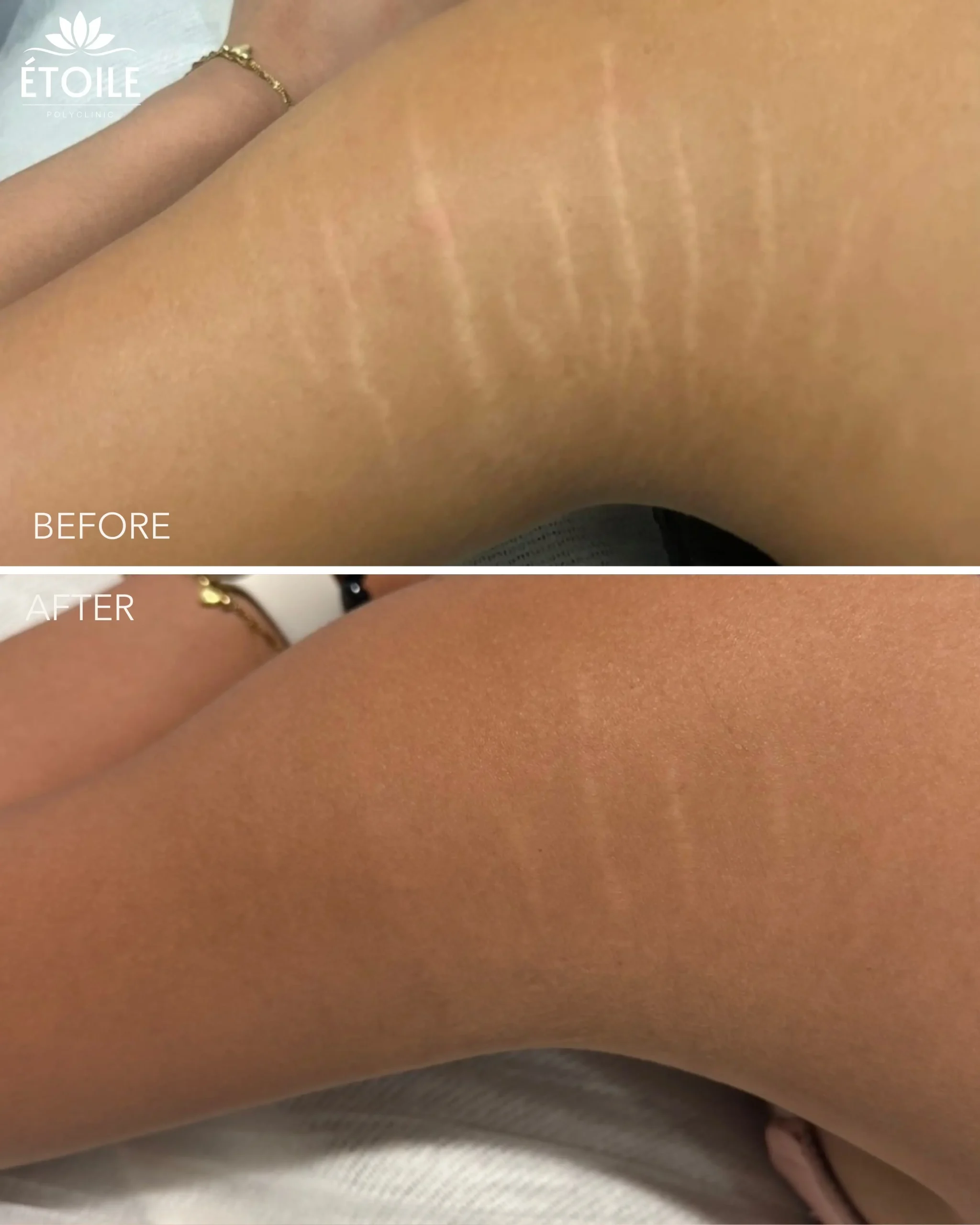sttretch marks treatment